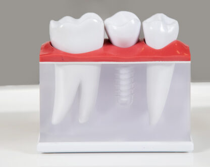 _How Implant