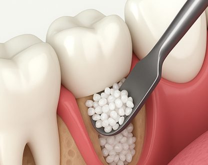 Pain 2 Weeks After Dental Bone Graft: When to See Your Dentist
