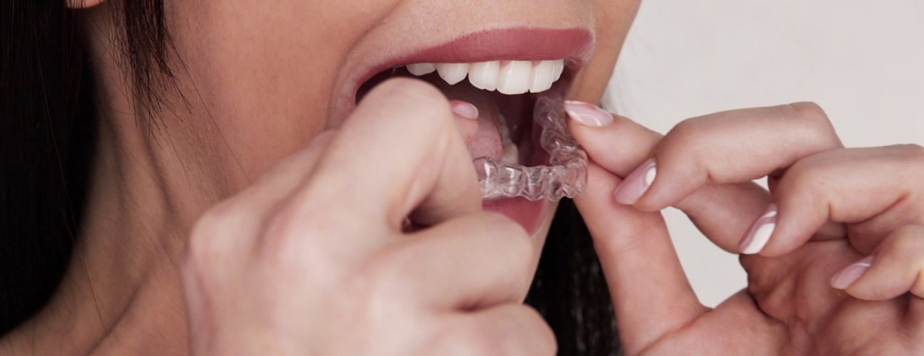 How to Fix a Crossbite in Adults With Invisalign