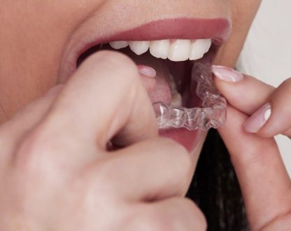 How to Fix a Crossbite in Adults With Invisalign