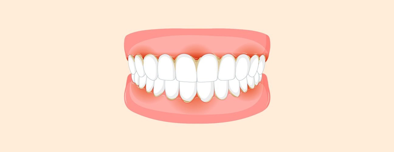 Bleeding Gums: A Warning You Shouldn’t Ignore