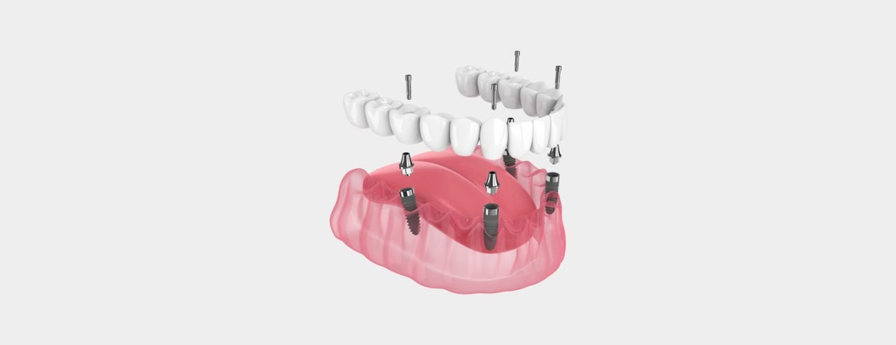 Transform Your Smile in Just One Day with All-on-4