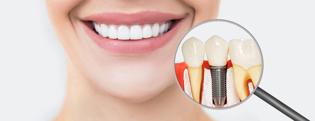 Understanding Dental Implants: A Comprehensive Guide to Costs and Timelines
