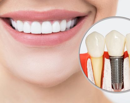 Understanding Dental Implants: A Comprehensive Guide to Costs and Timelines